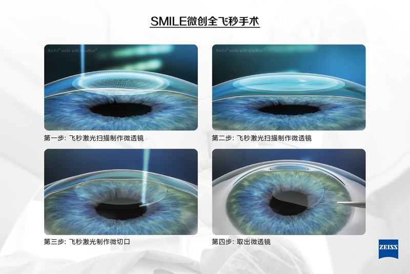 全飛秒矯正近視：更加適合用眼高要求群體